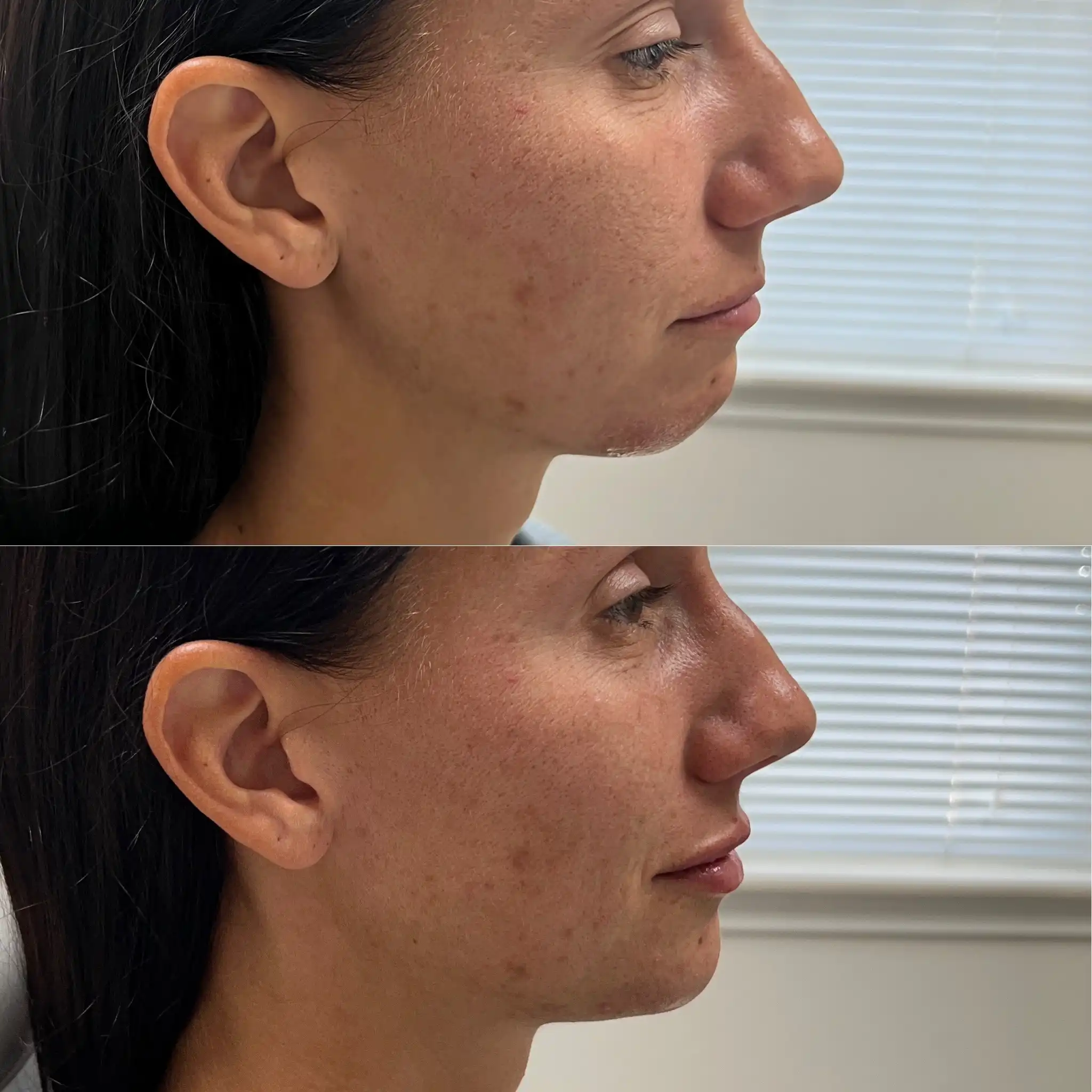 Facial Filler Gallery B in Stillwater, OK