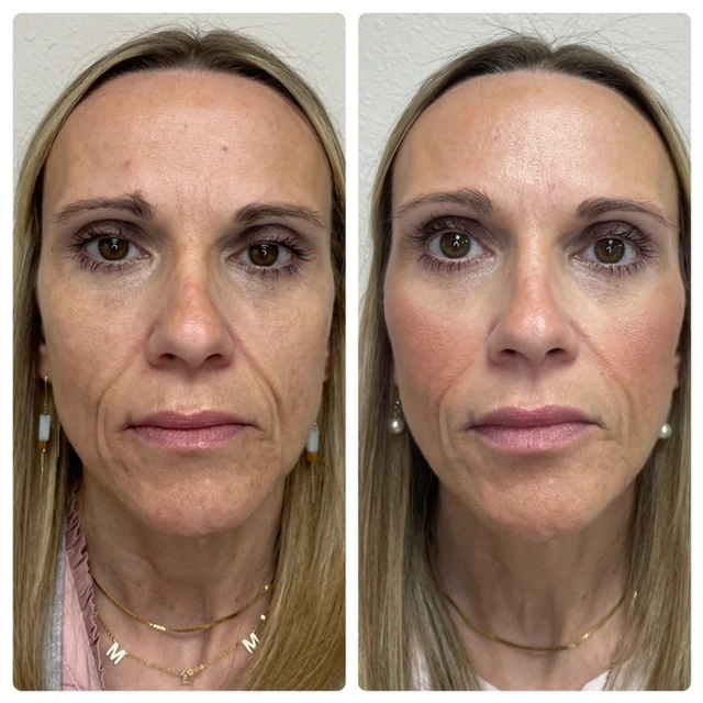 Facial Filler Gallery c in Stillwater, OK