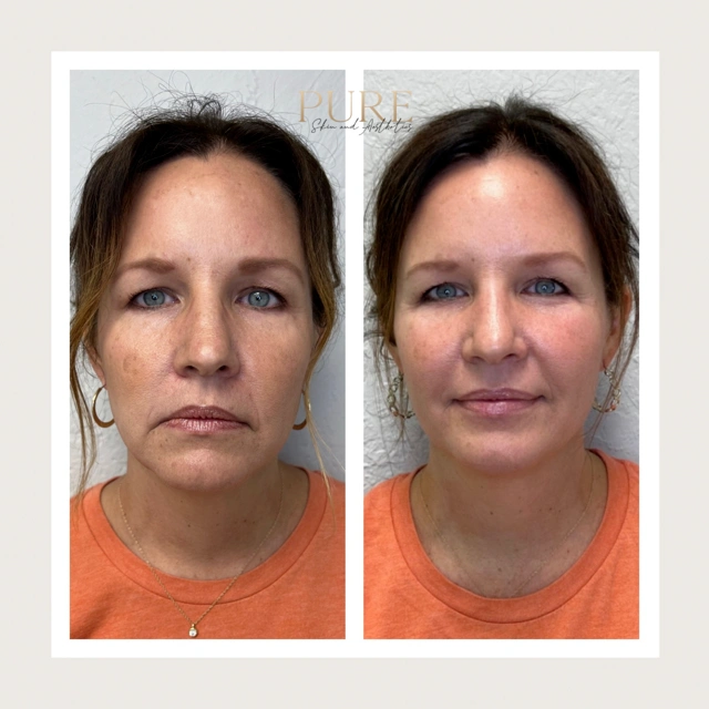 Facial Filler Gallery e in Stillwater, OK