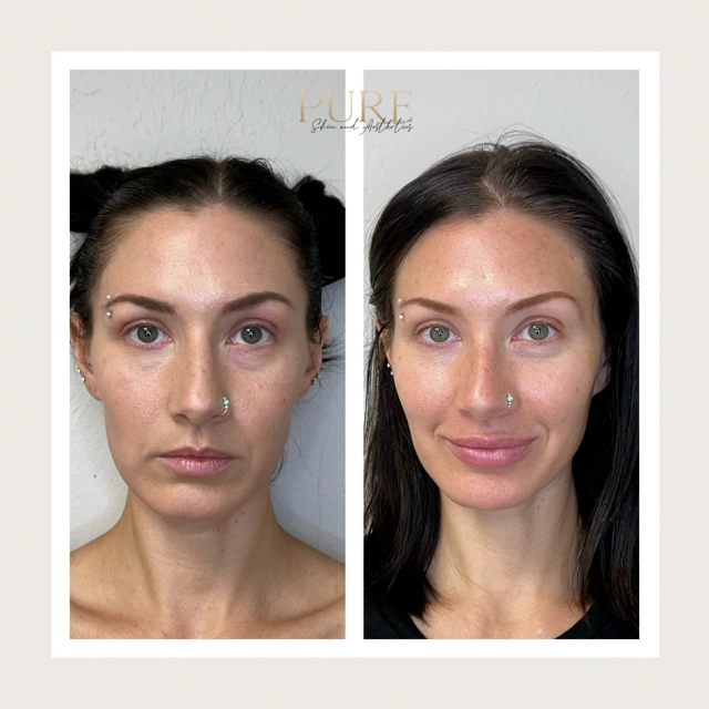 Facial Filler Gallery f in Stillwater, OK
