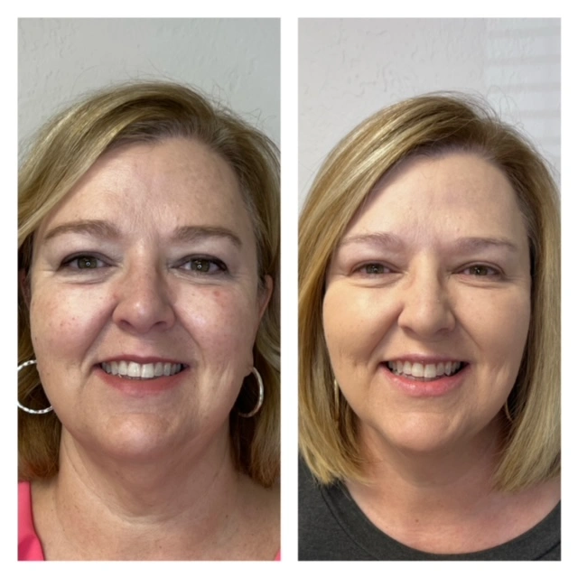 Facial Filler Gallery i in Stillwater, OK