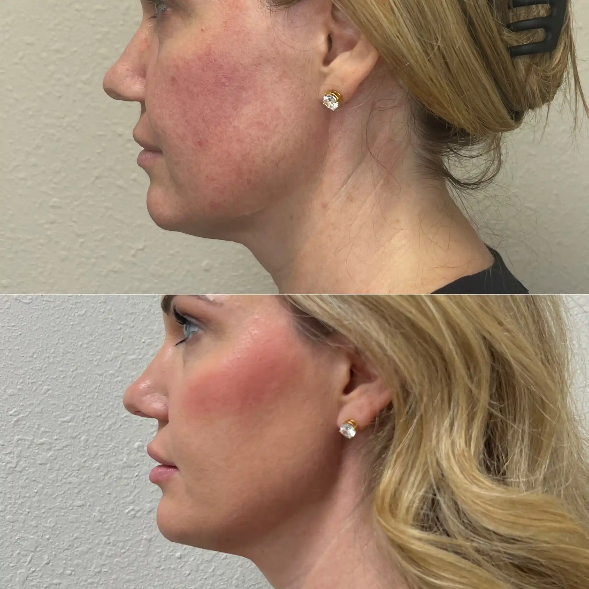 Facial Filler Gallery in Stillwater, OK