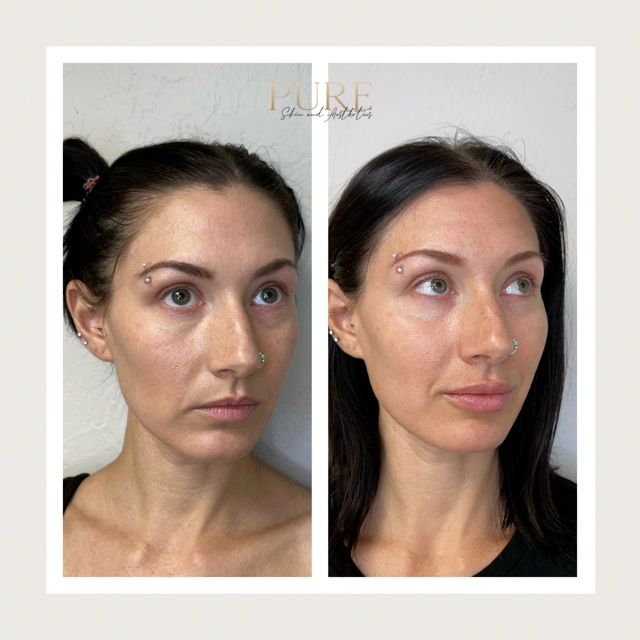 Facial Filler Gallery k in Stillwater, OK