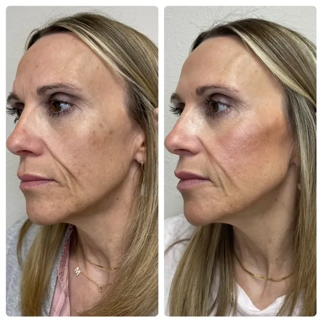Facial Filler Gallery p in Stillwater, OK.webp