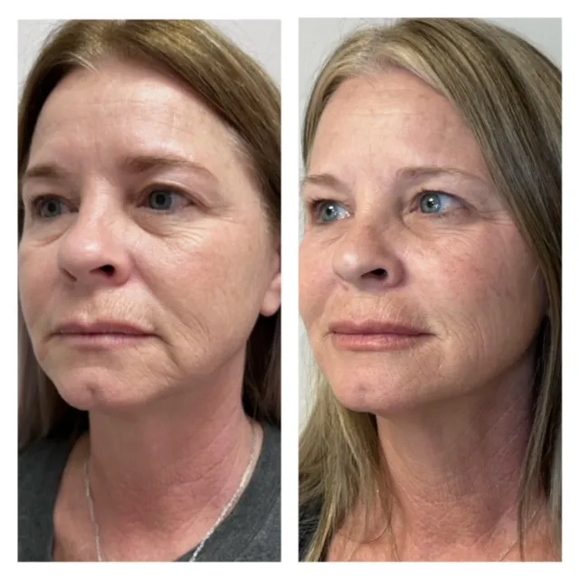 Facial Filler Gallery q in Stillwater, OK.webp