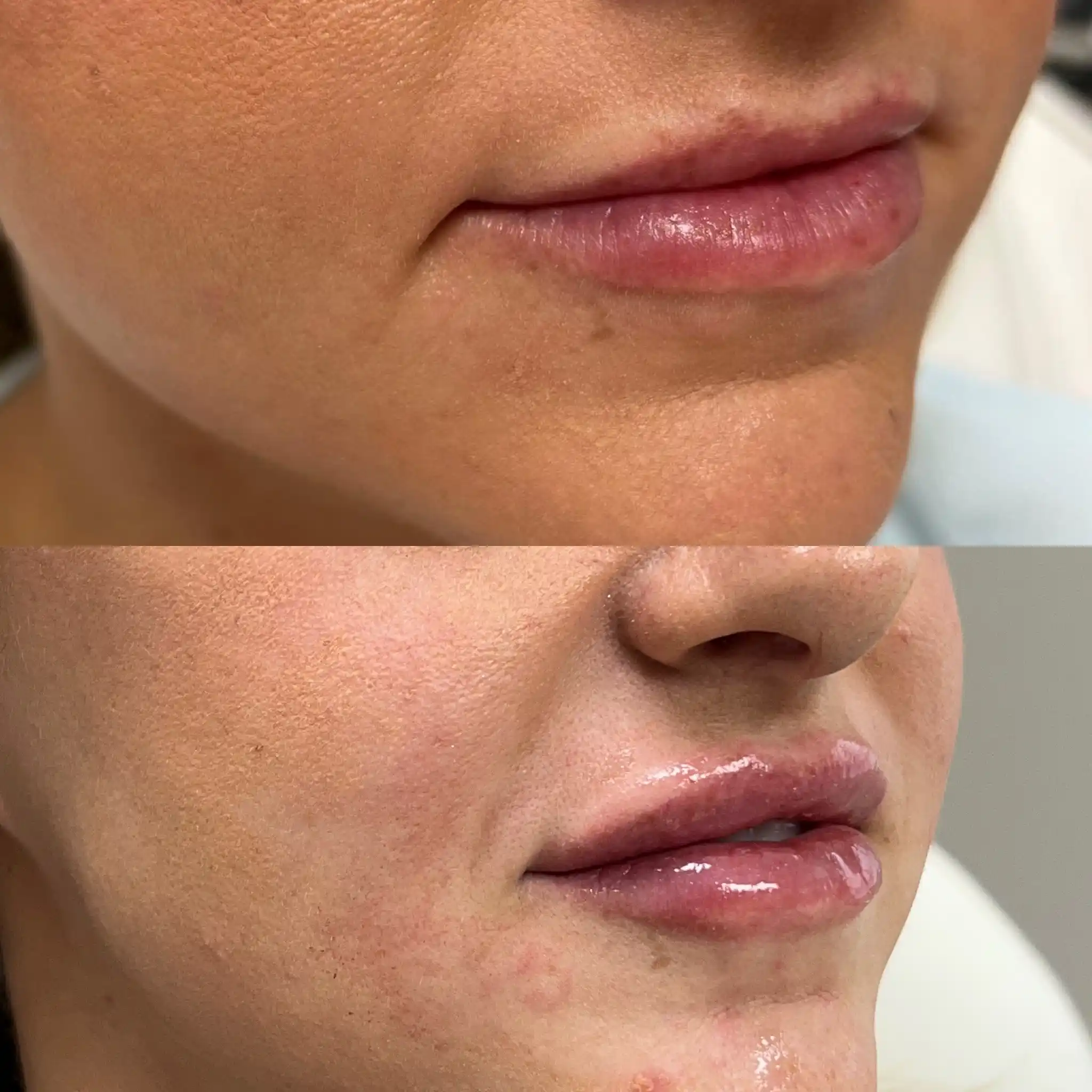 Lip Filler Gallery B in Stillwater, OK.webp