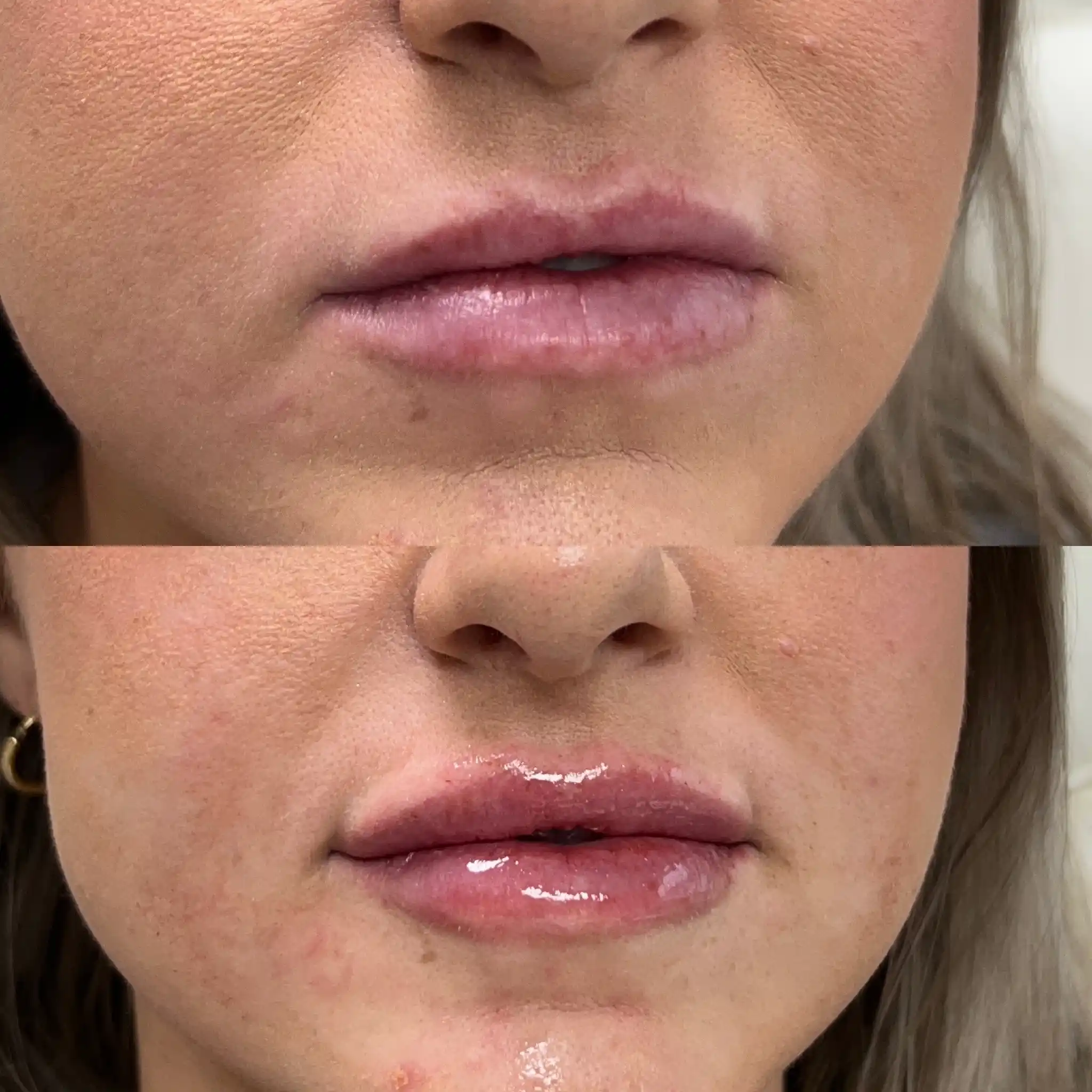 Lip Filler Gallery D in Stillwater, OK.webp