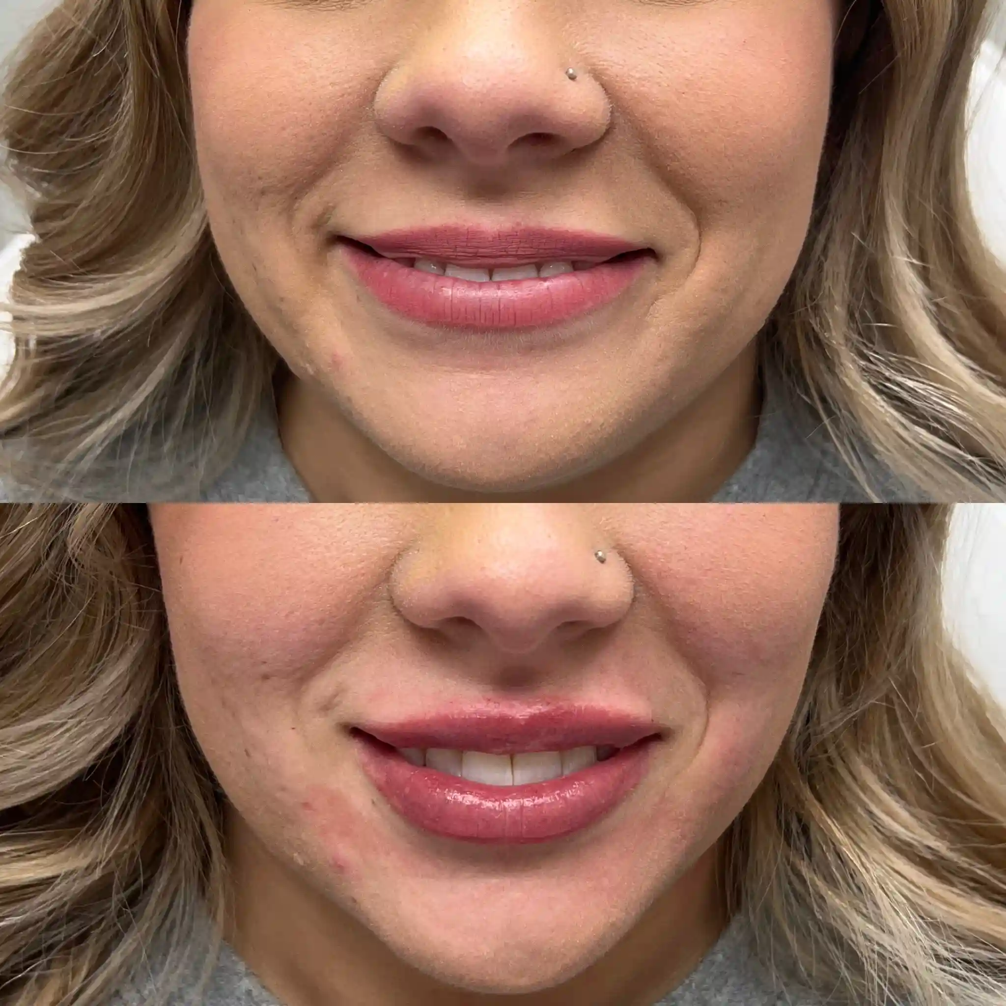Lip Filler Gallery E in Stillwater, OK.webp