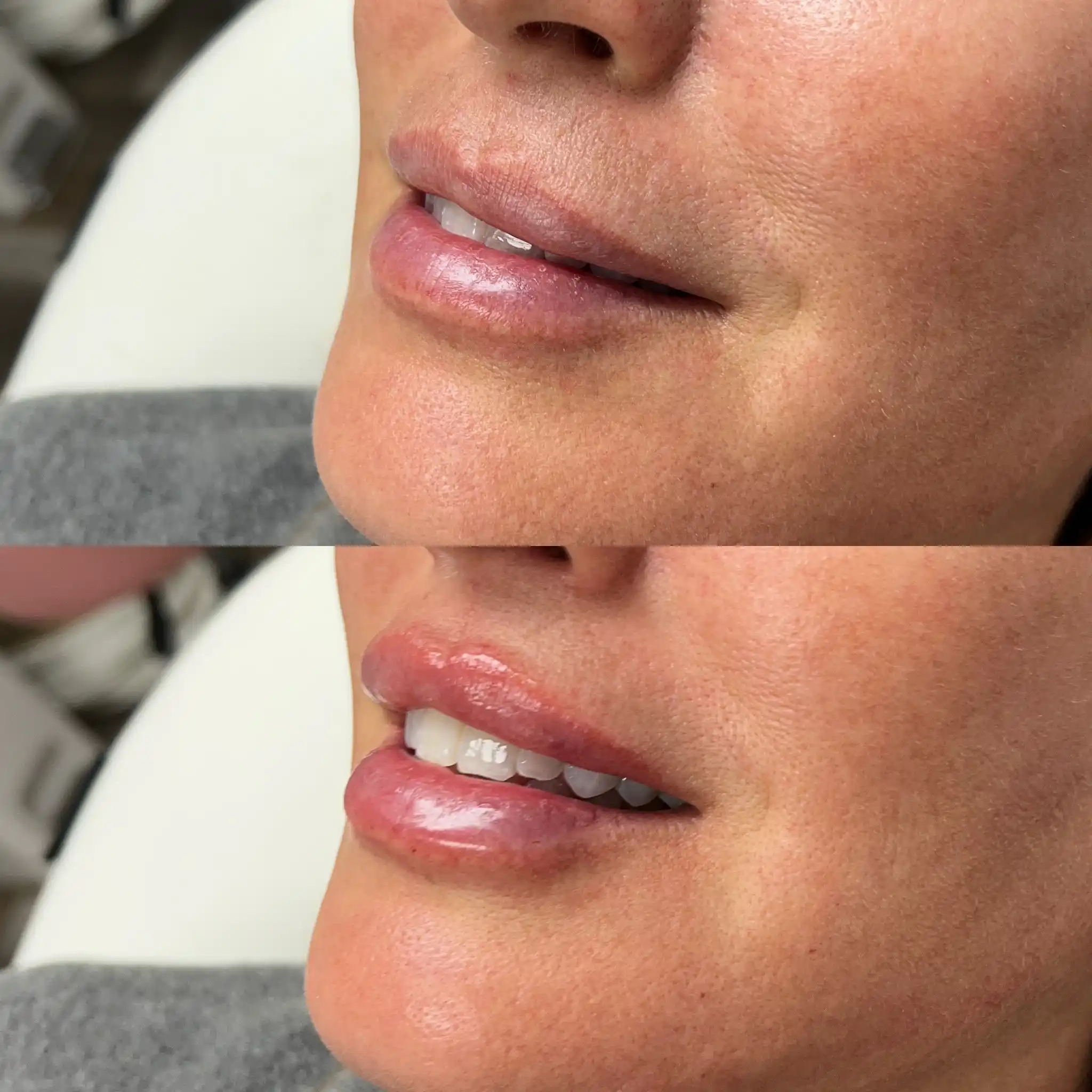 Lip Filler Gallery in Stillwater, OK