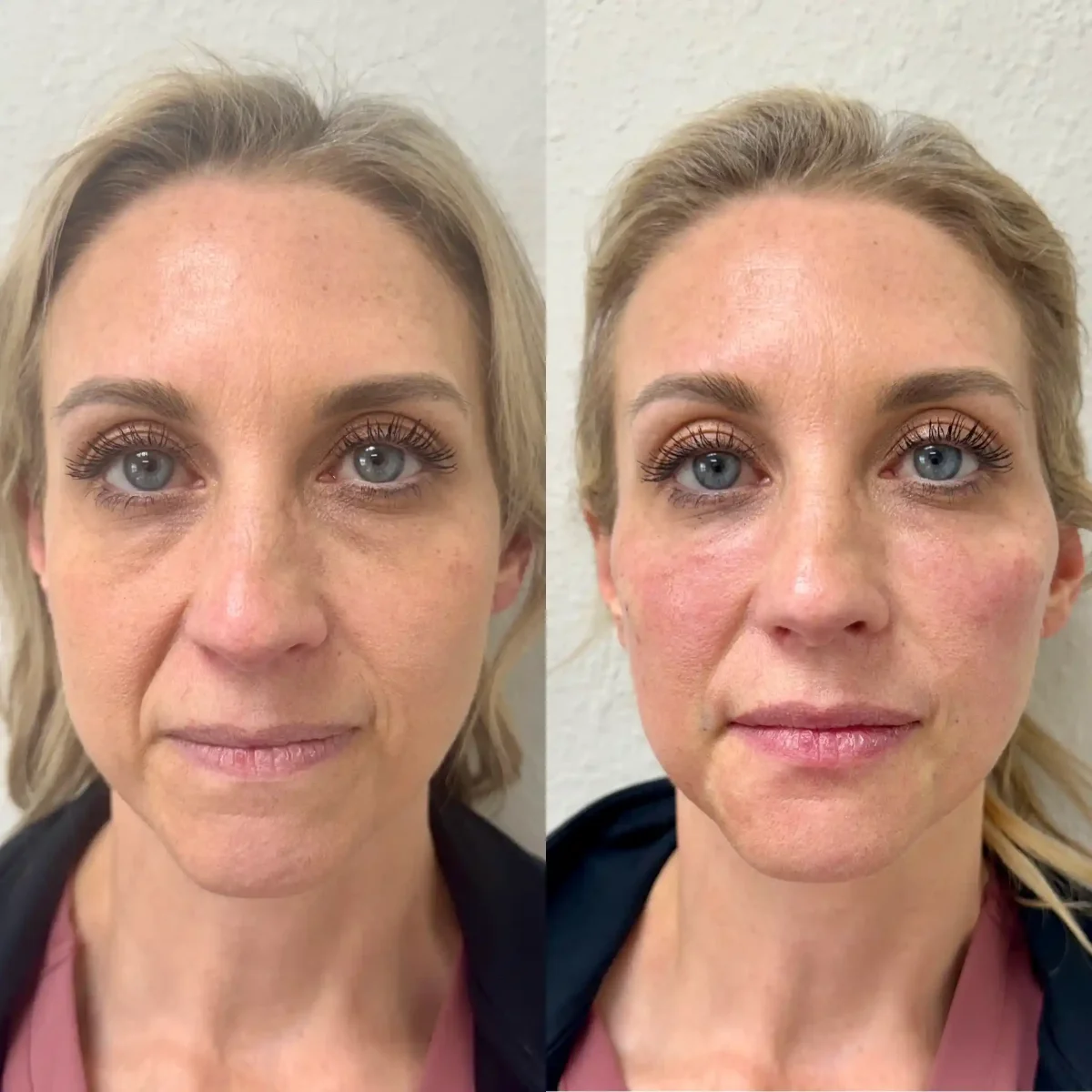 EZ Gel_Regenerative A-Pure Skin and Aesthetics in-Stillwater-OK