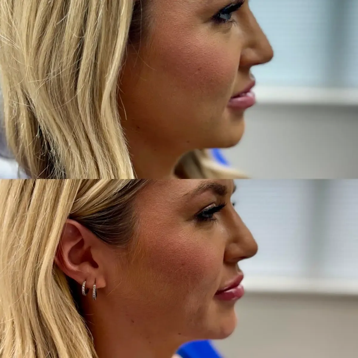 Filler Ab-Pure Skin and Aesthetics in-Stillwater-OK