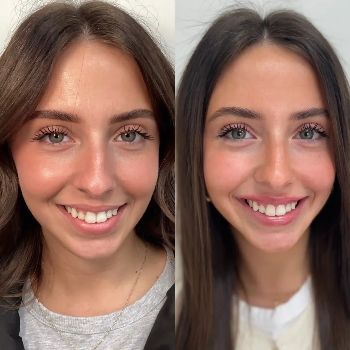 Filler Ac-Pure Skin and Aesthetics in-Stillwater-OK