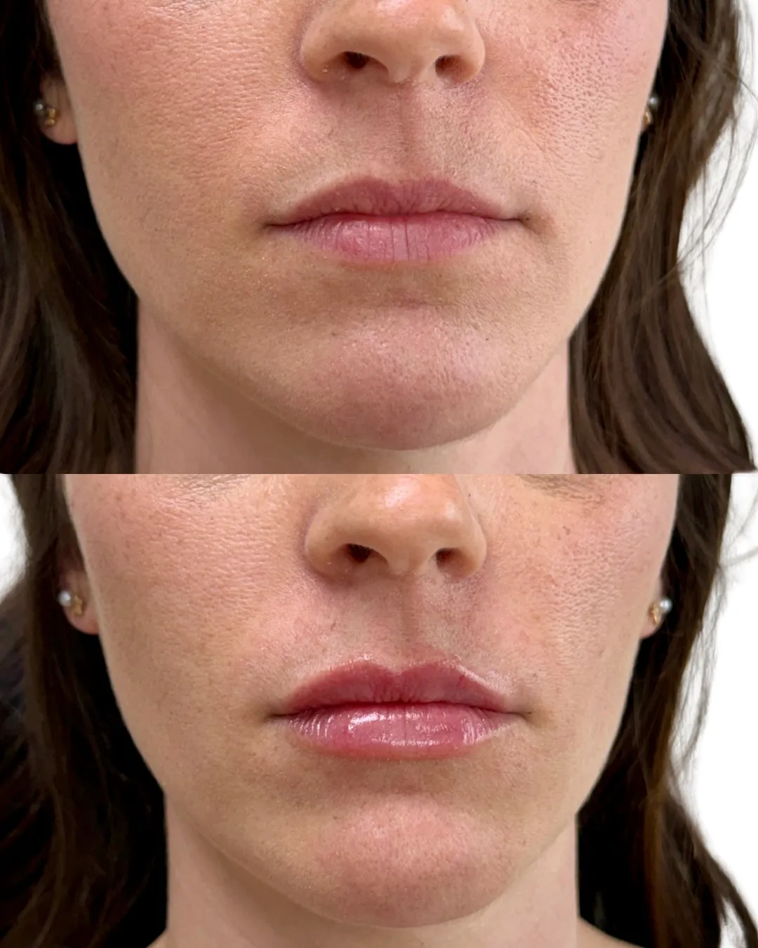 Filler Ae-Pure Skin and Aesthetics in-Stillwater-OK