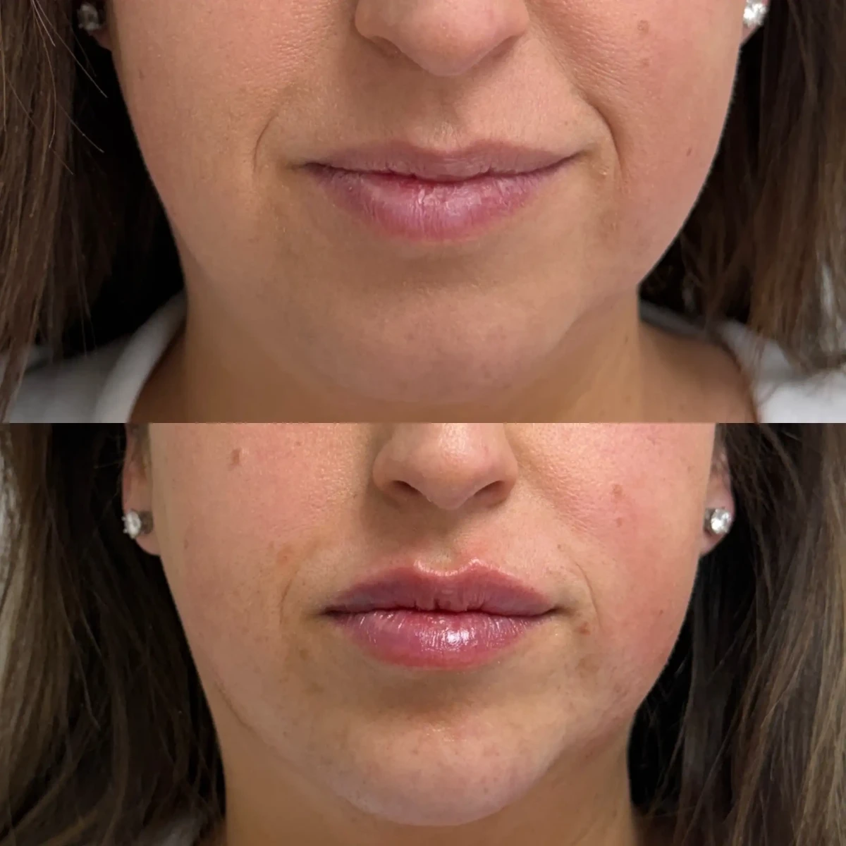 Filler-Pure Skin and Aesthetics in-Stillwater-OK