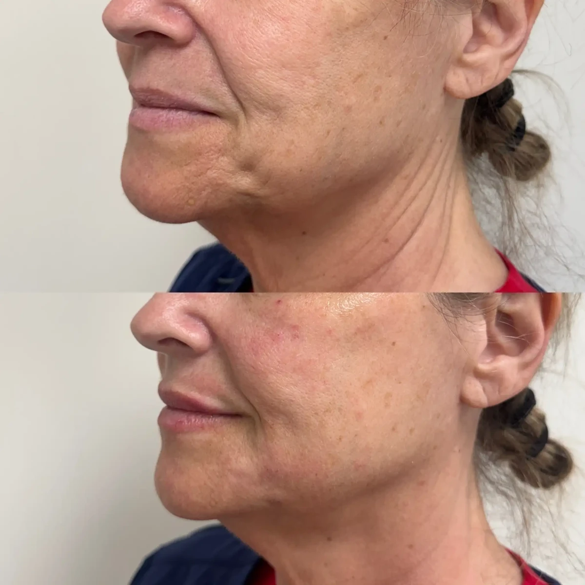 Filler b-Pure Skin and Aesthetics in-Stillwater-OK