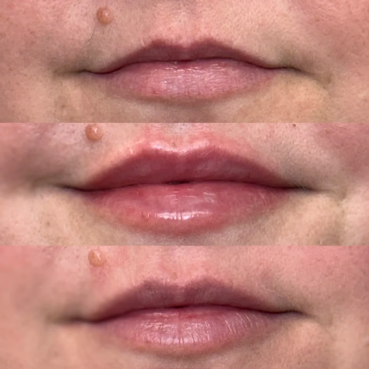 Filler d-Pure Skin and Aesthetics in-Stillwater-OK