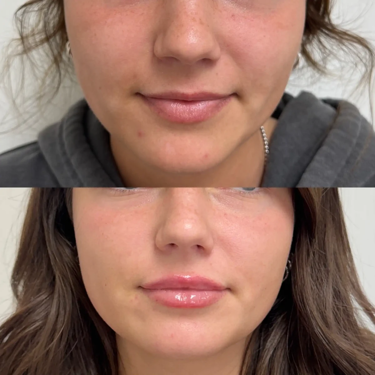 Filler e-Pure Skin and Aesthetics in-Stillwater-OK