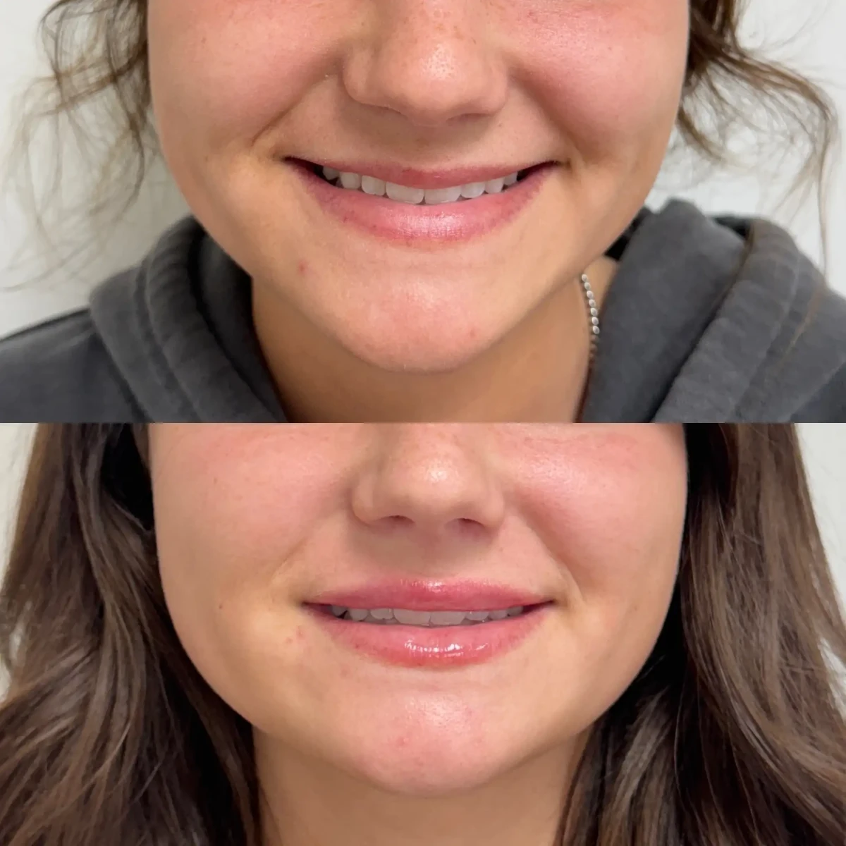 Filler f-Pure Skin and Aesthetics in-Stillwater-OK