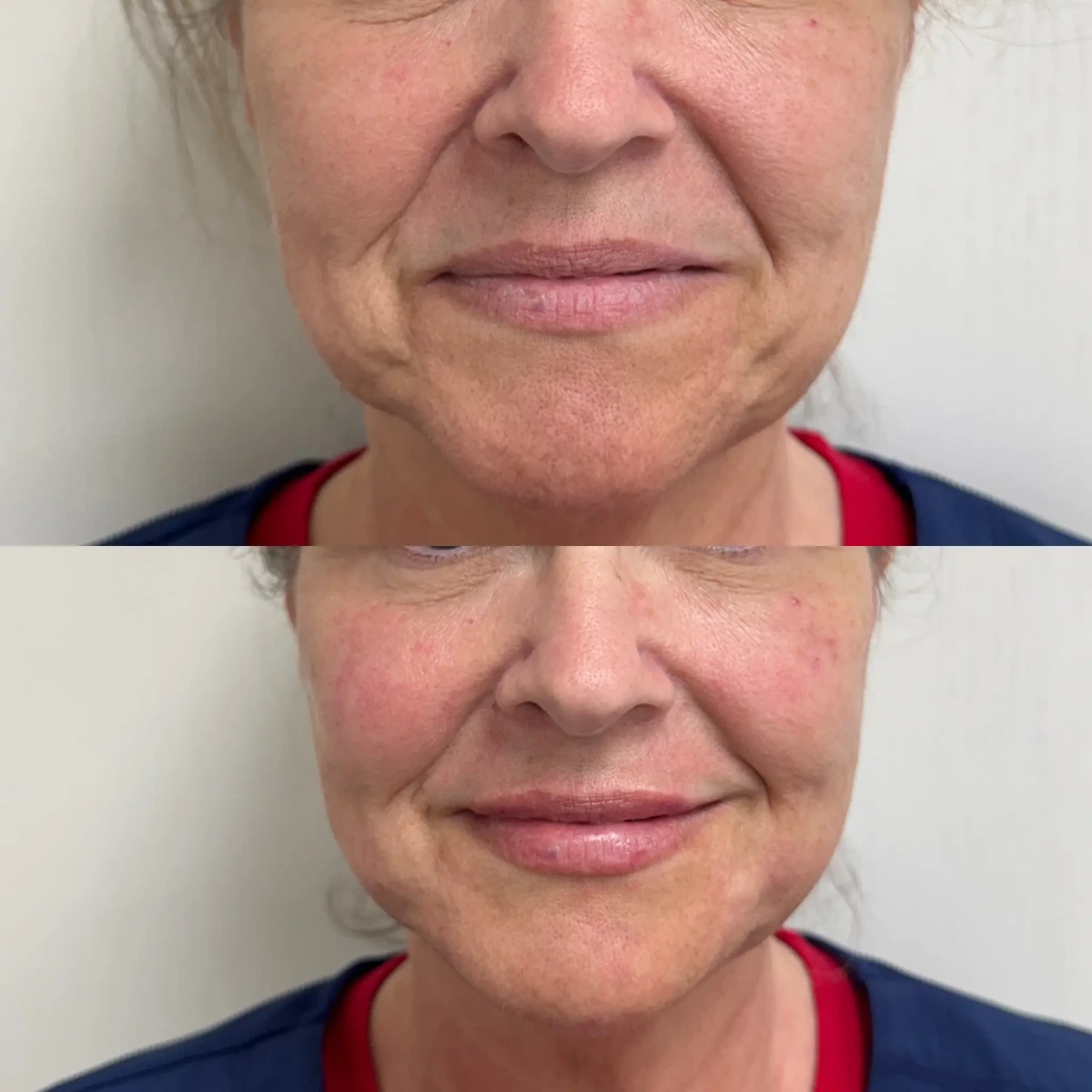 Filler h-Pure Skin and Aesthetics in-Stillwater-OK (1)