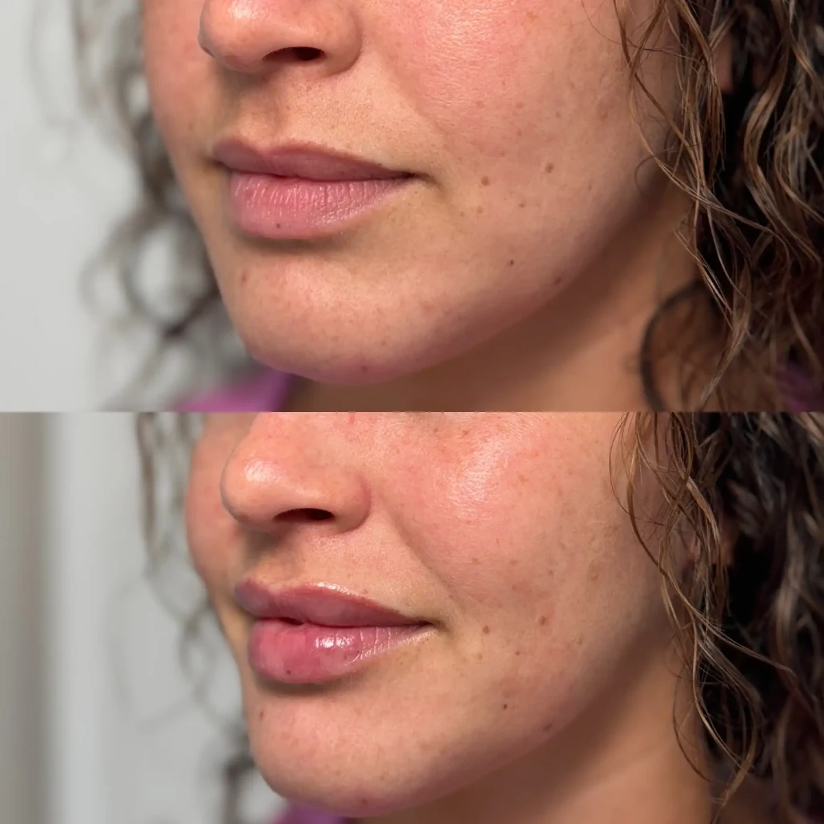 Filler i-Pure Skin and Aesthetics in-Stillwater-OK (1)