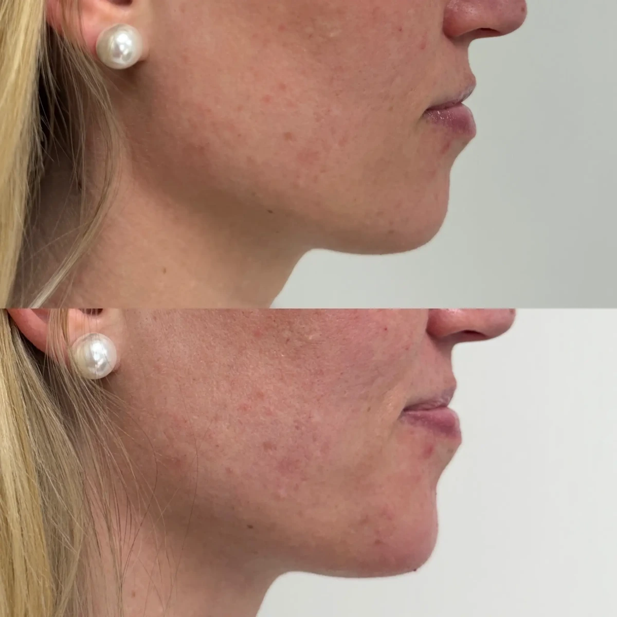 Filler i-Pure Skin and Aesthetics in-Stillwater-OK