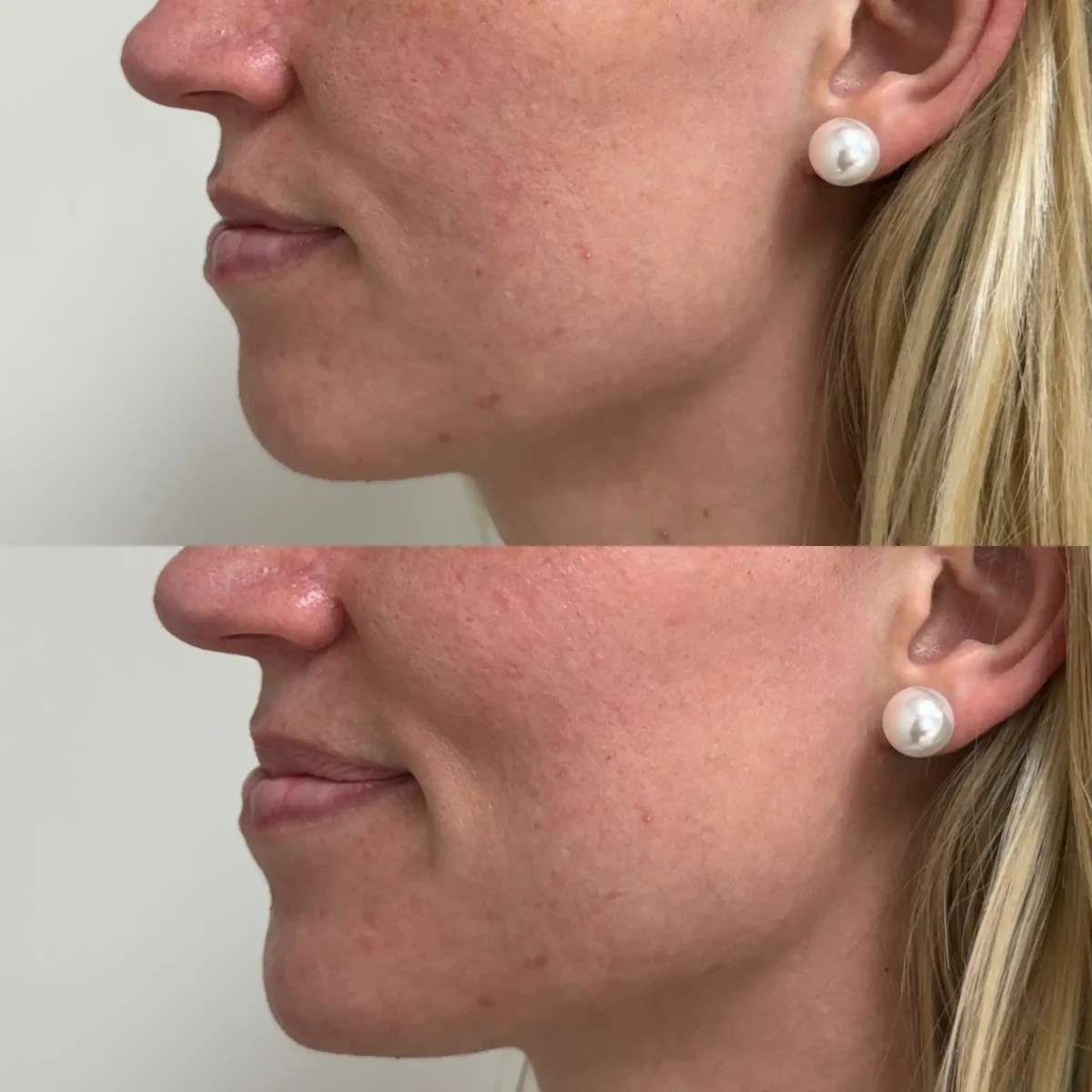 Filler j-Pure Skin and Aesthetics in-Stillwater-OK