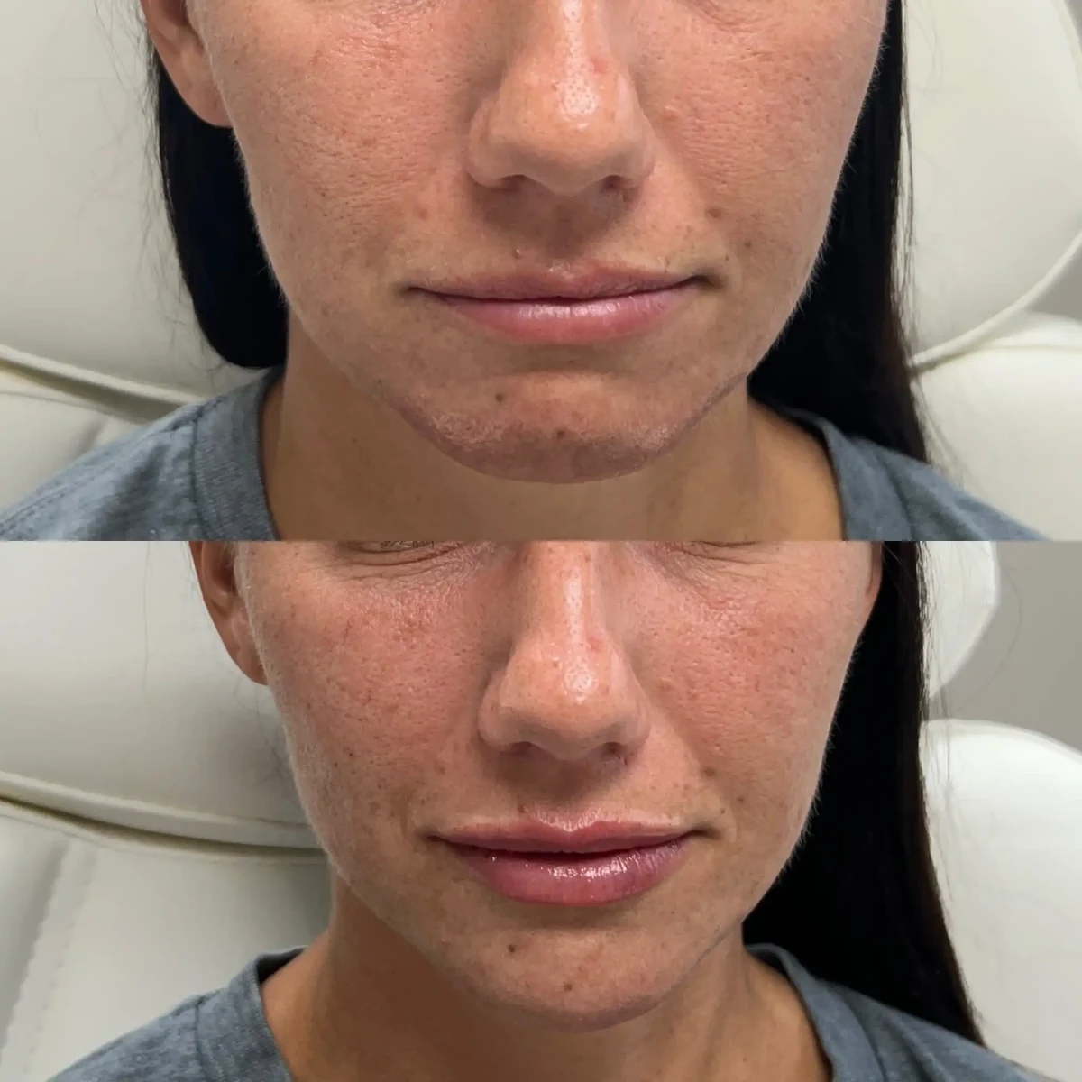 Filler s-Pure Skin and Aesthetics in-Stillwater-OK