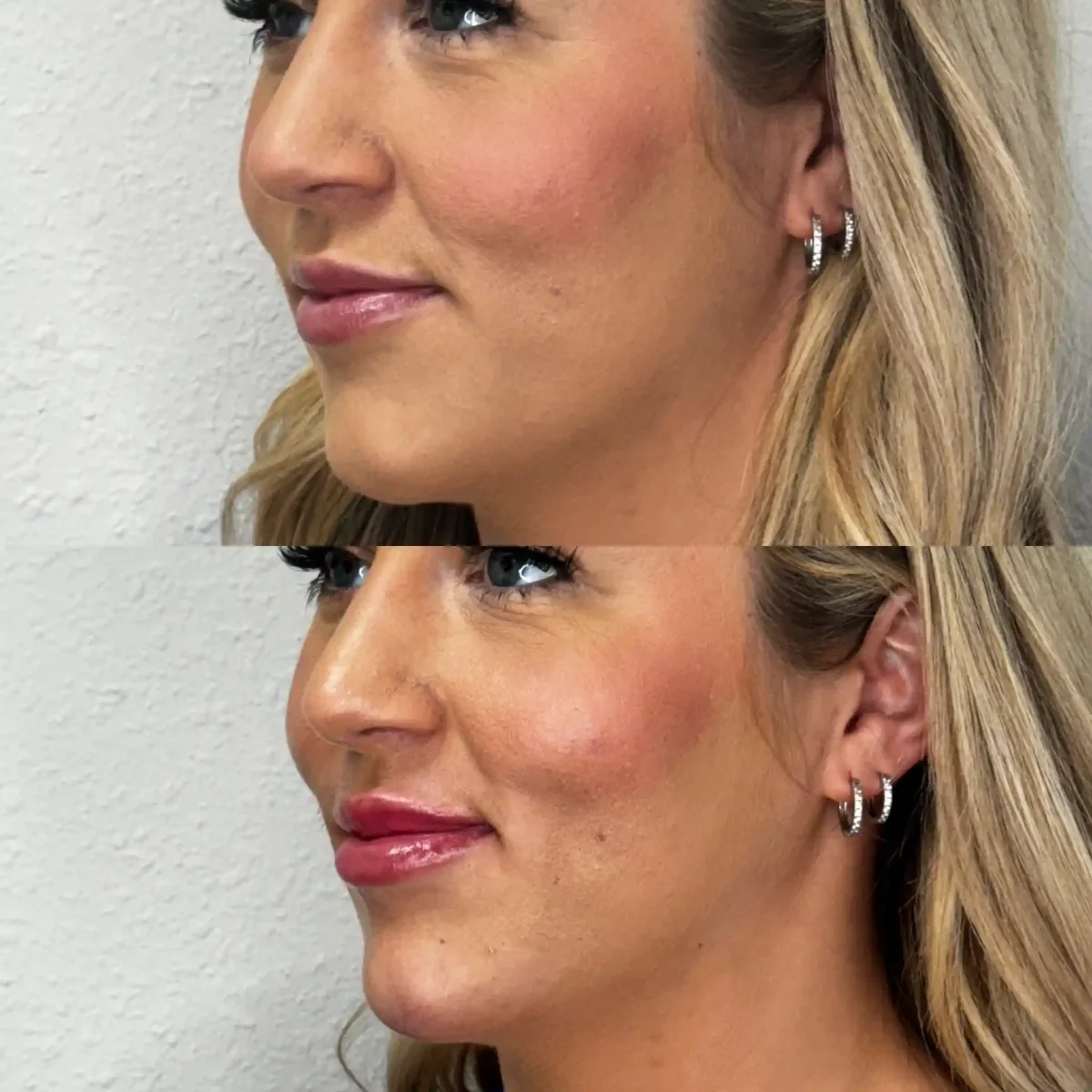Filler v-Pure Skin and Aesthetics in-Stillwater-OK