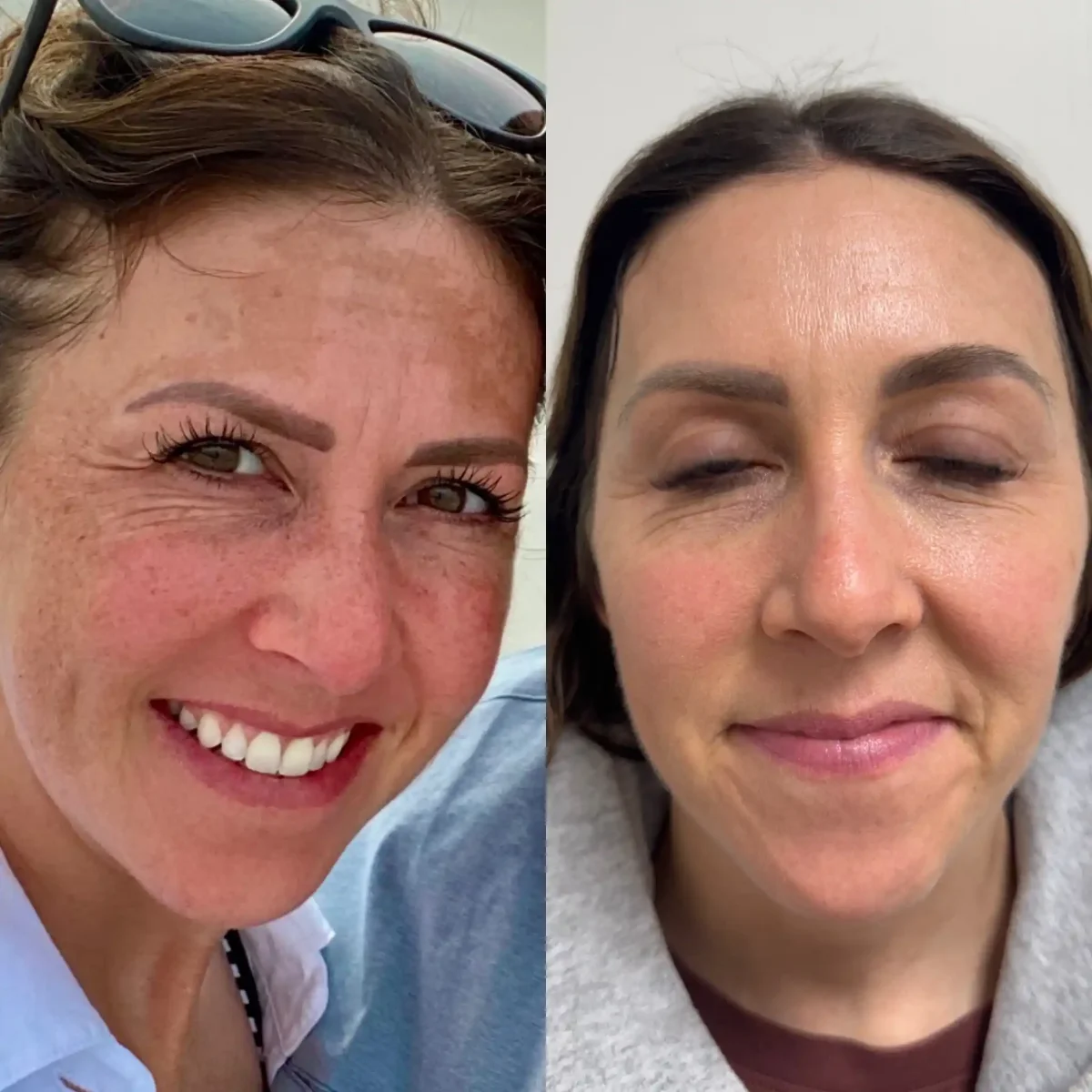 Laser treatment-Pure Skin and Aesthetics in-Stillwater-OK (1)