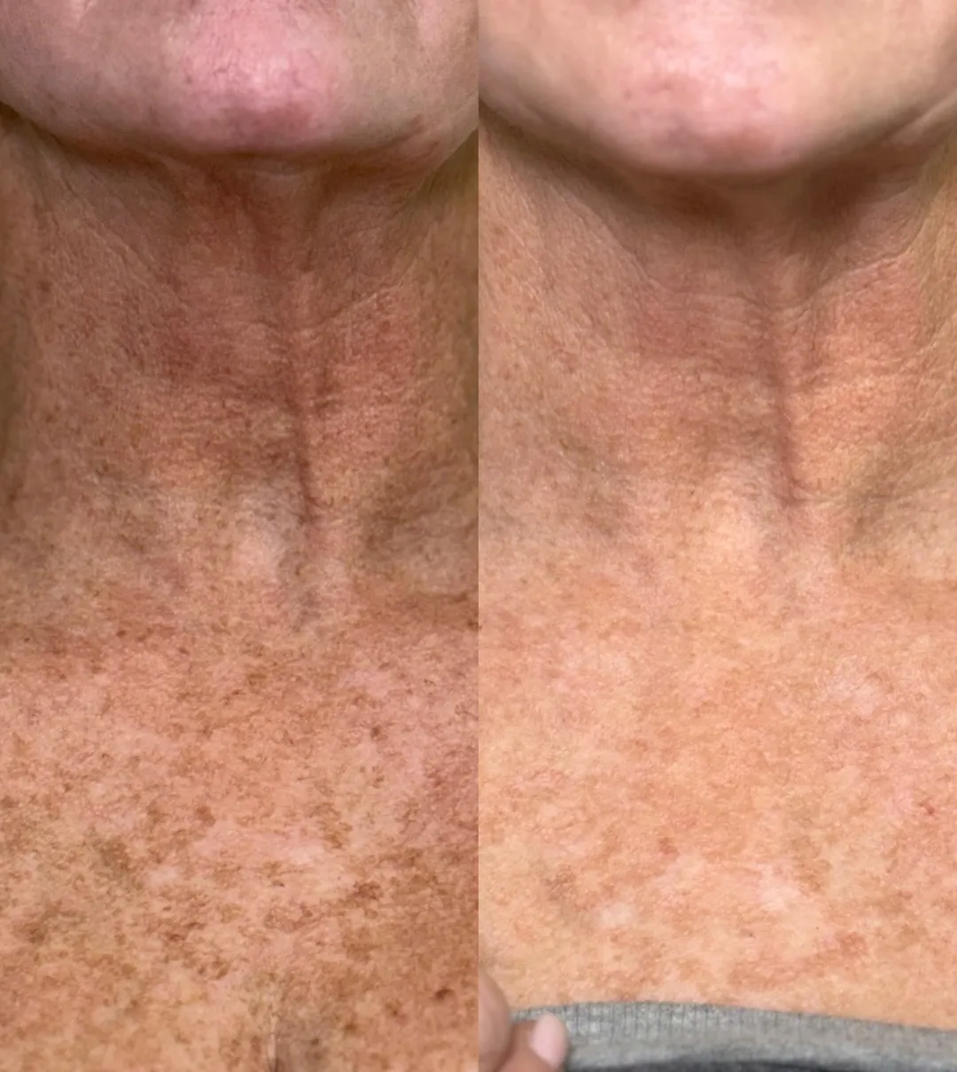 Laser treatment-Pure Skin and Aesthetics in-Stillwater-OK