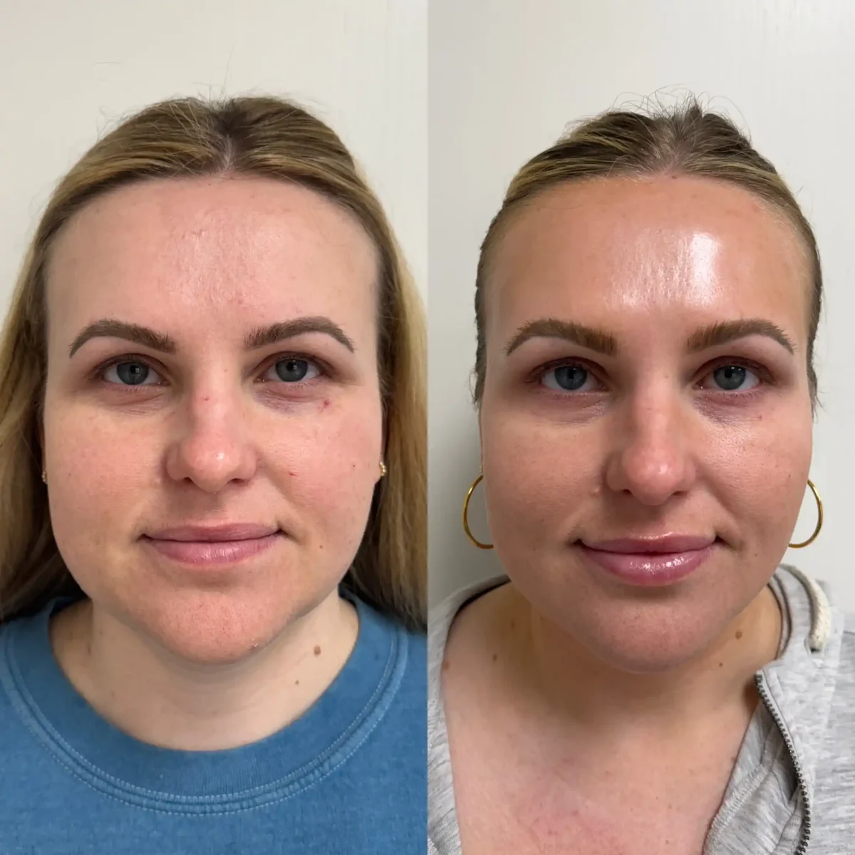 Microneedling A-Pure Skin and Aesthetics in-Stillwater-OK