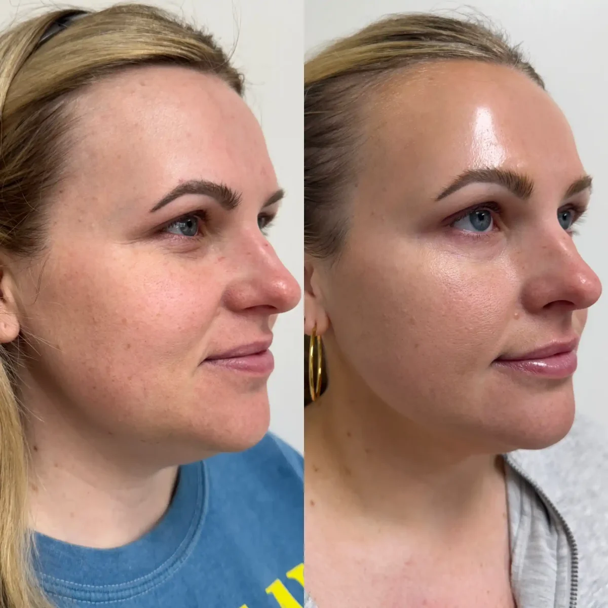 Microneedling-Pure Skin and Aesthetics in-Stillwater-OK