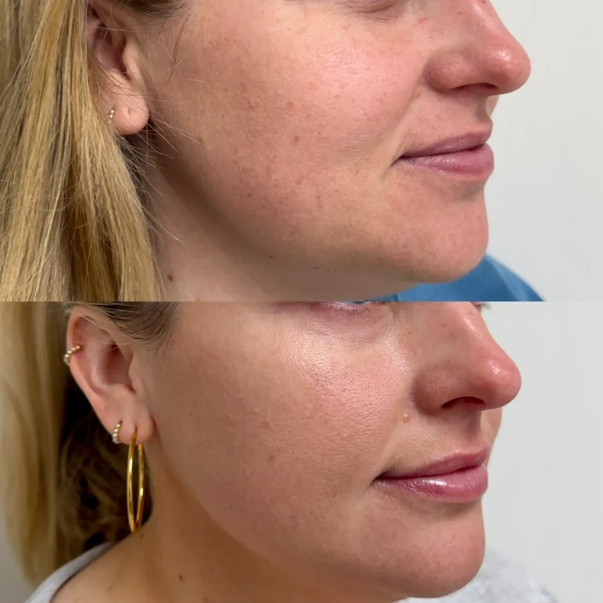 Microneedling b-Pure Skin and Aesthetics in-Stillwater-OK