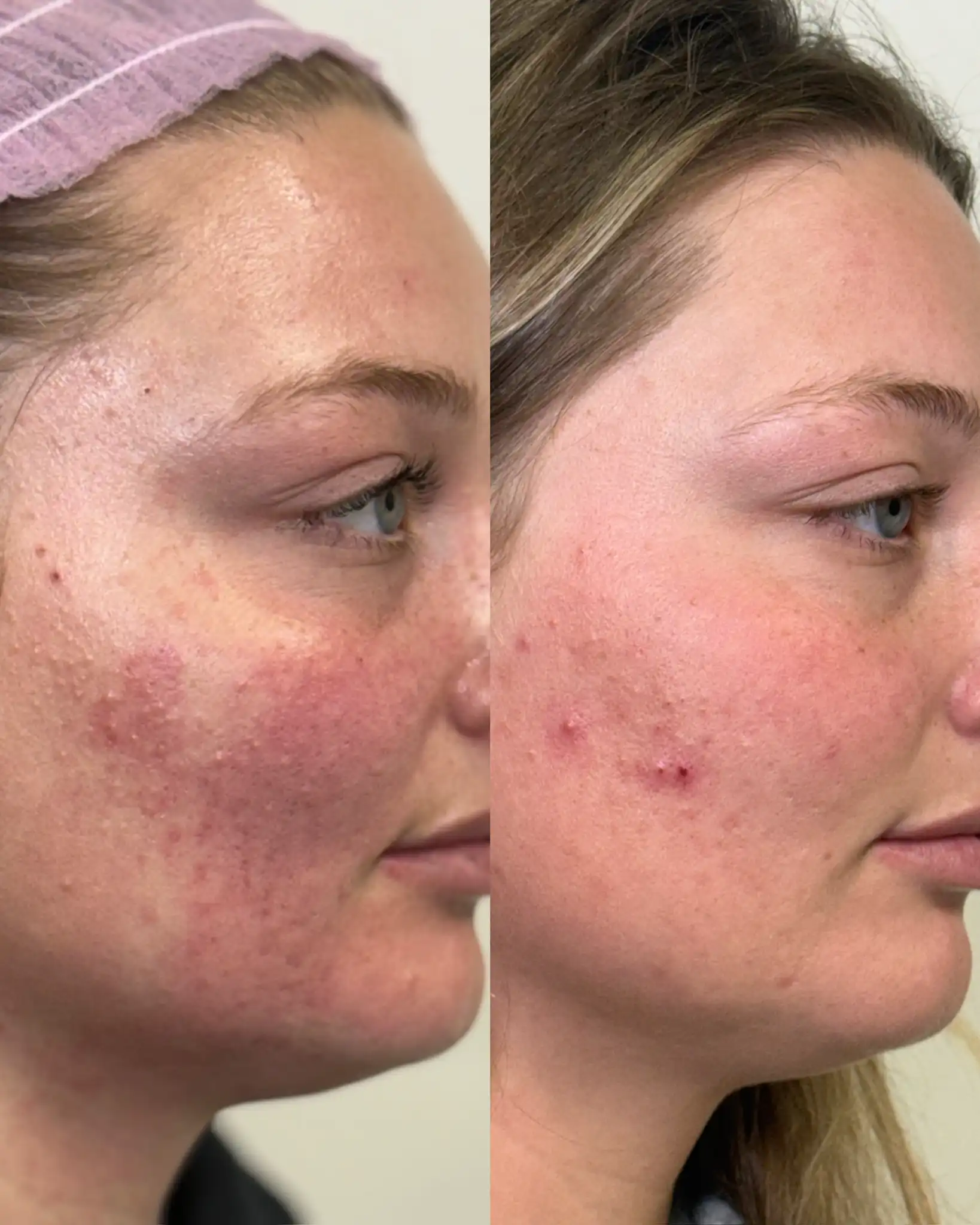 Microneedling d-Pure Skin and Aesthetics in-Stillwater-OK