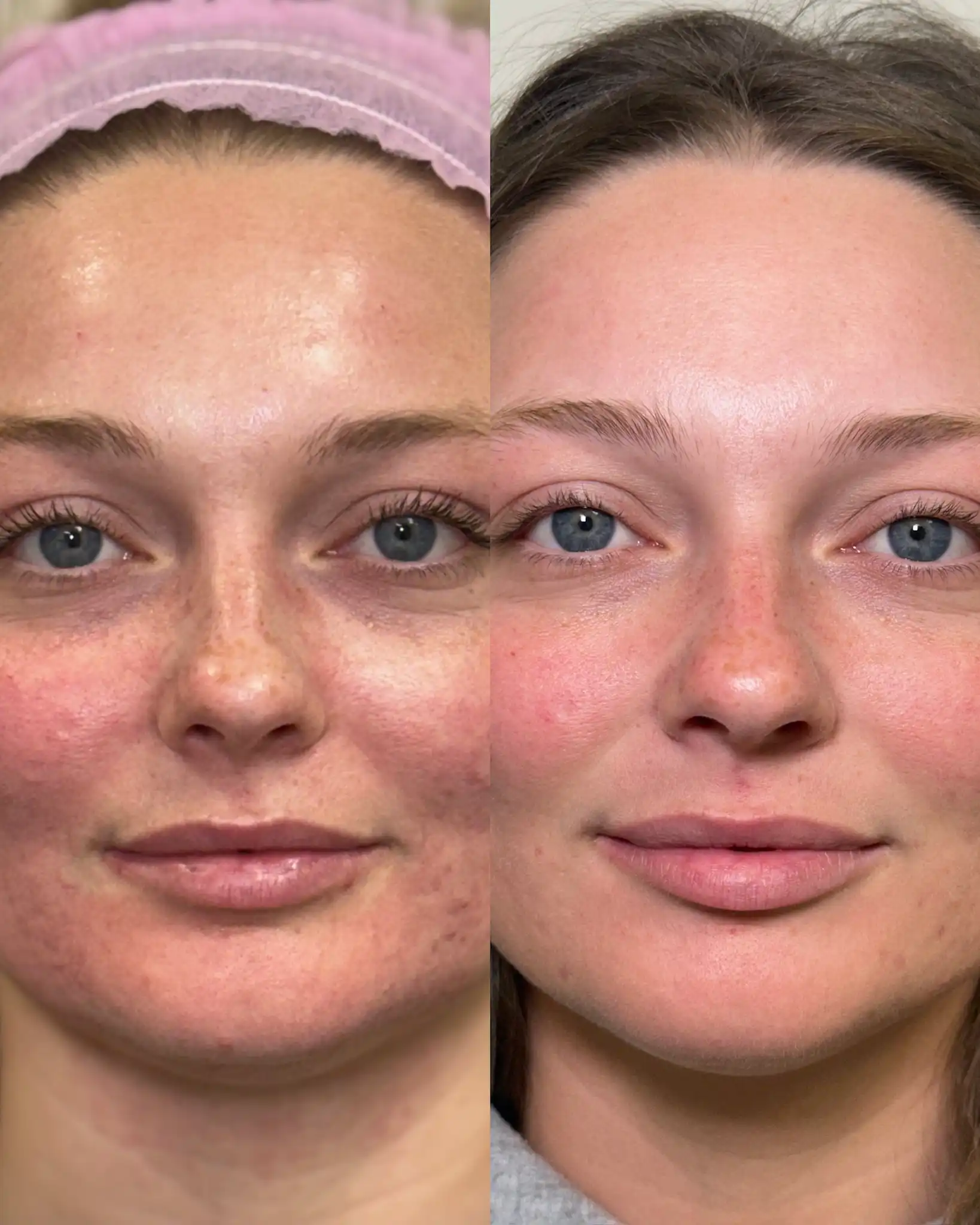 Microneedling f-Pure Skin and Aesthetics in-Stillwater-OK