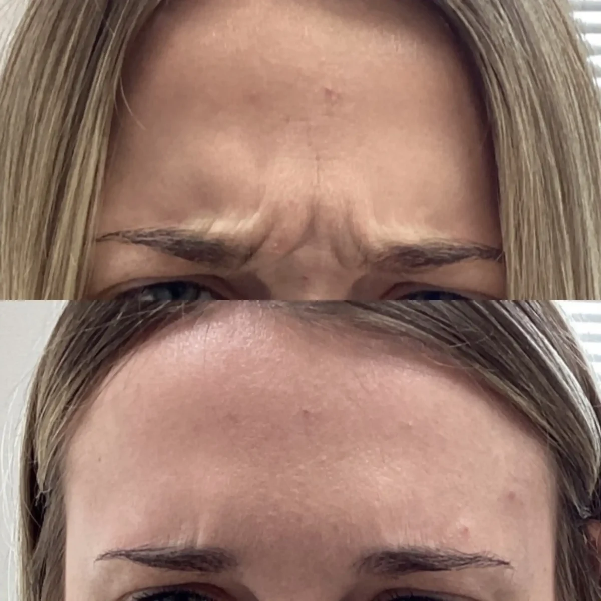 Wrinkle Relaxers b-Pure Skin and Aesthetics in-Stillwater-OK