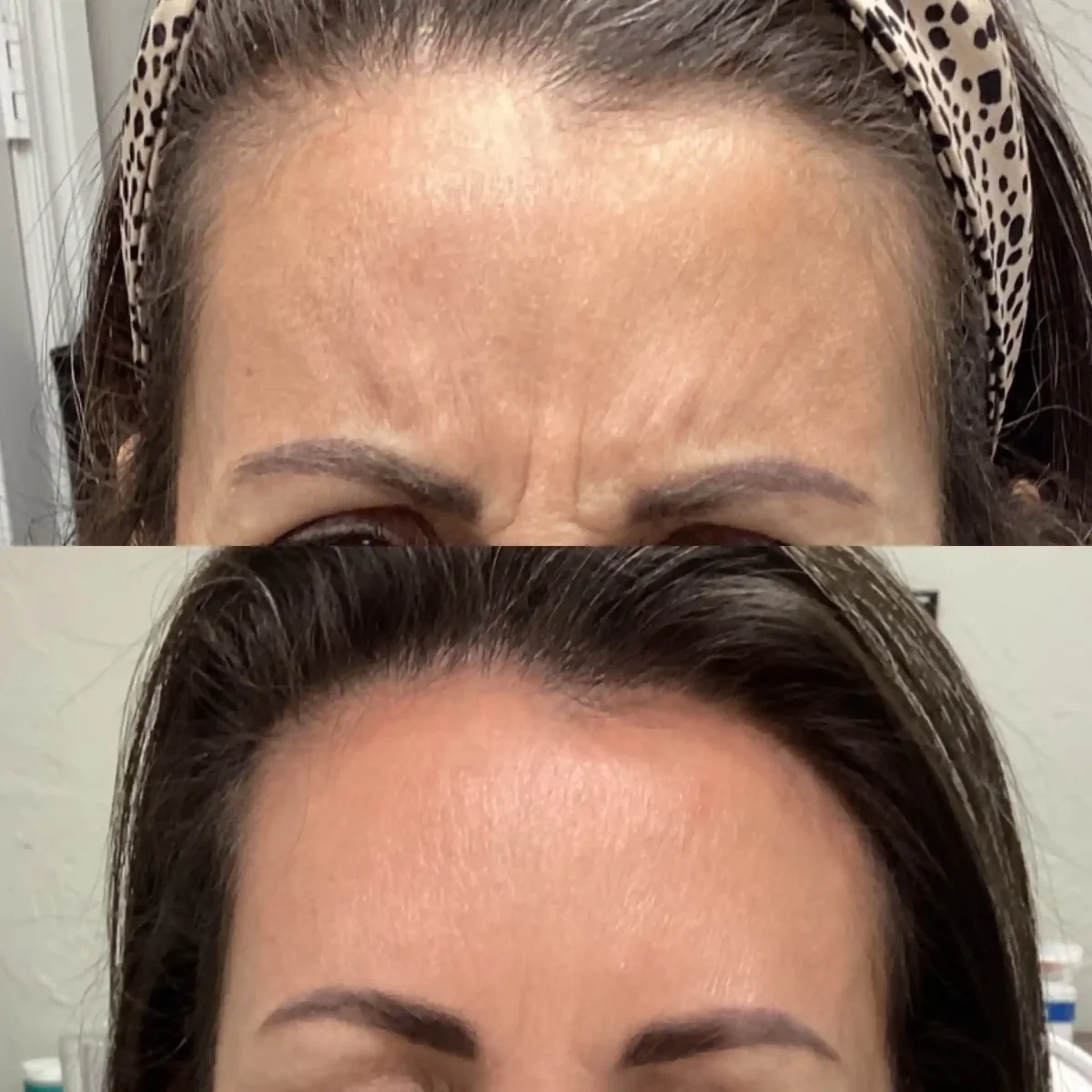 Wrinkle Relaxers d-Pure Skin and Aesthetics in-Stillwater-OK