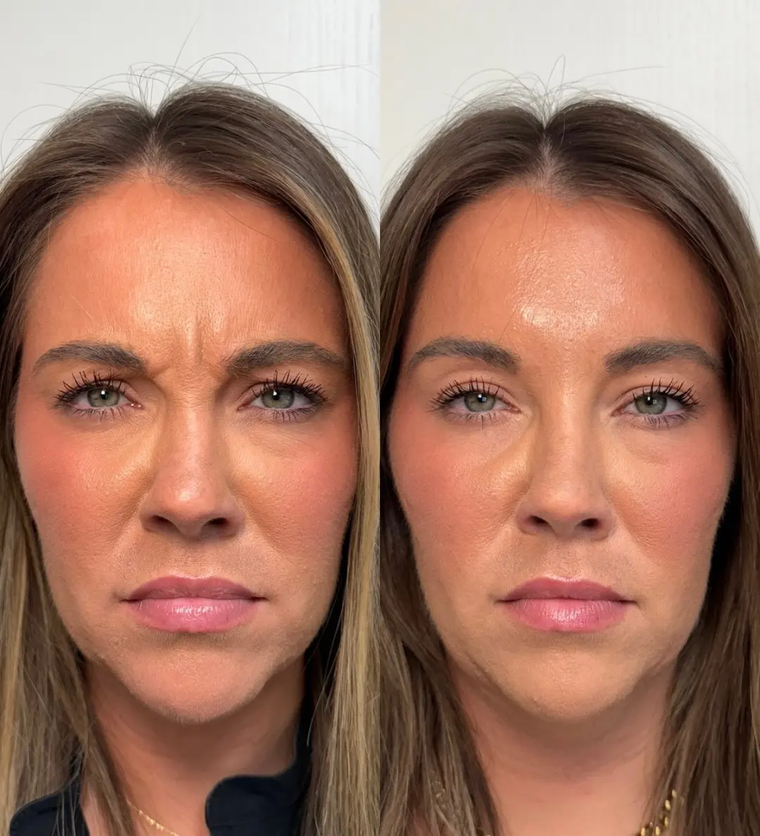 Wrinkle Relaxers f-Pure Skin and Aesthetics in-Stillwater-OK