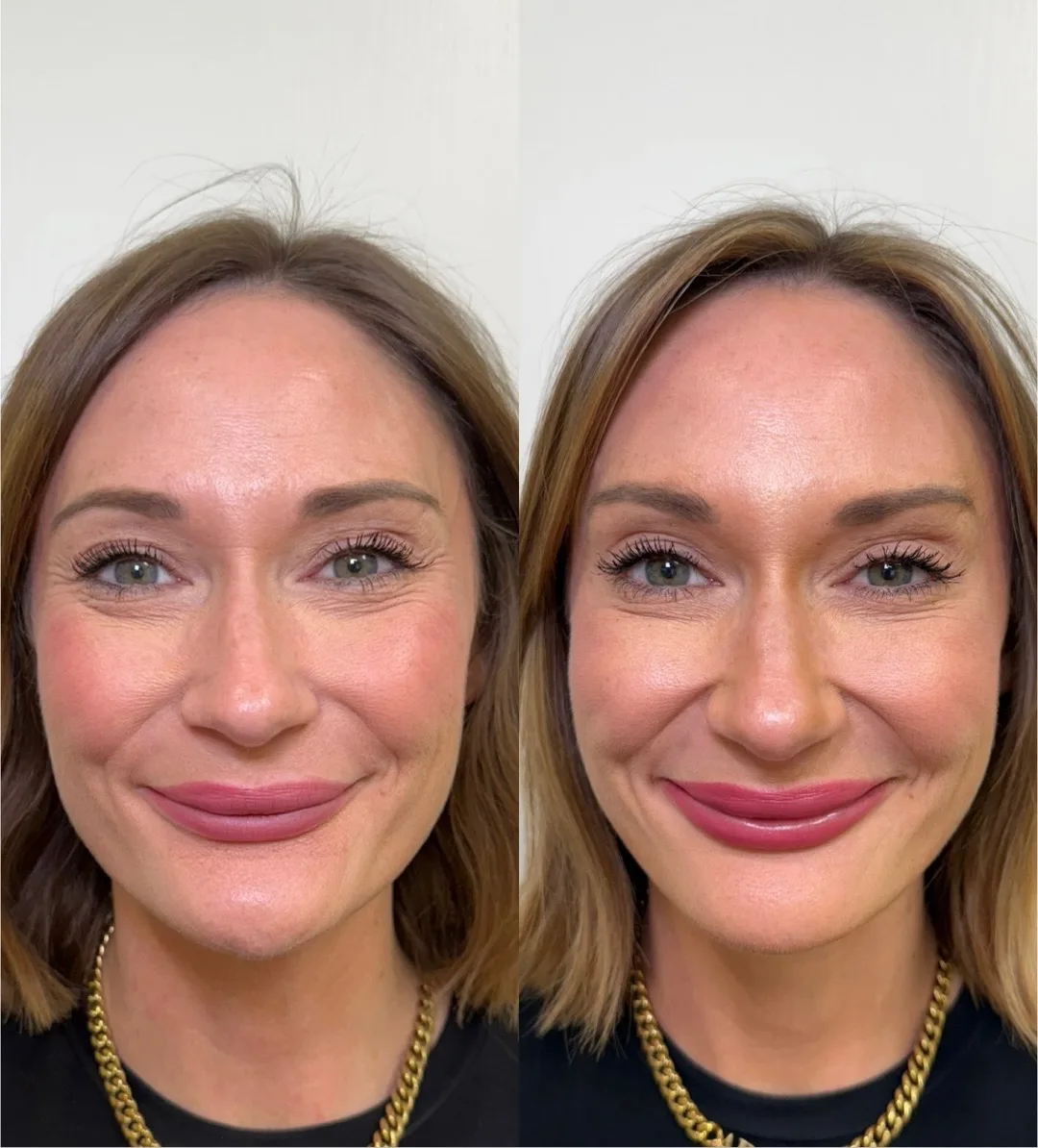 Wrinkle Relaxers g-Pure Skin and Aesthetics in-Stillwater-OK