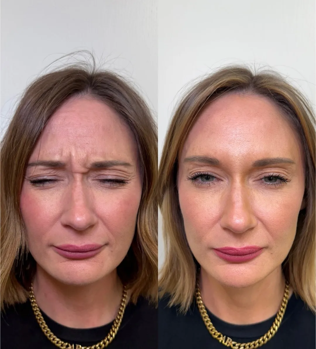 Wrinkle Relaxers h-Pure Skin and Aesthetics in-Stillwater-OK