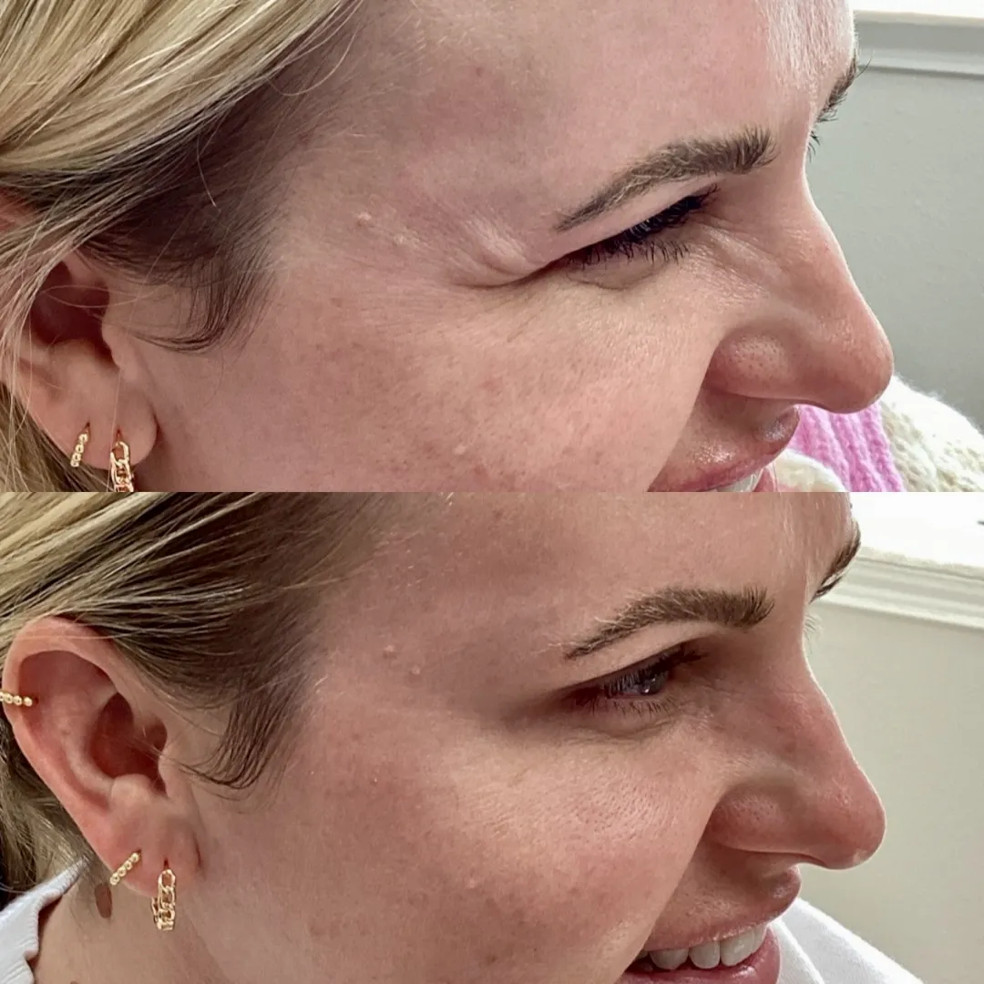 Wrinkle Relaxers j-Pure Skin and Aesthetics in-Stillwater-OK