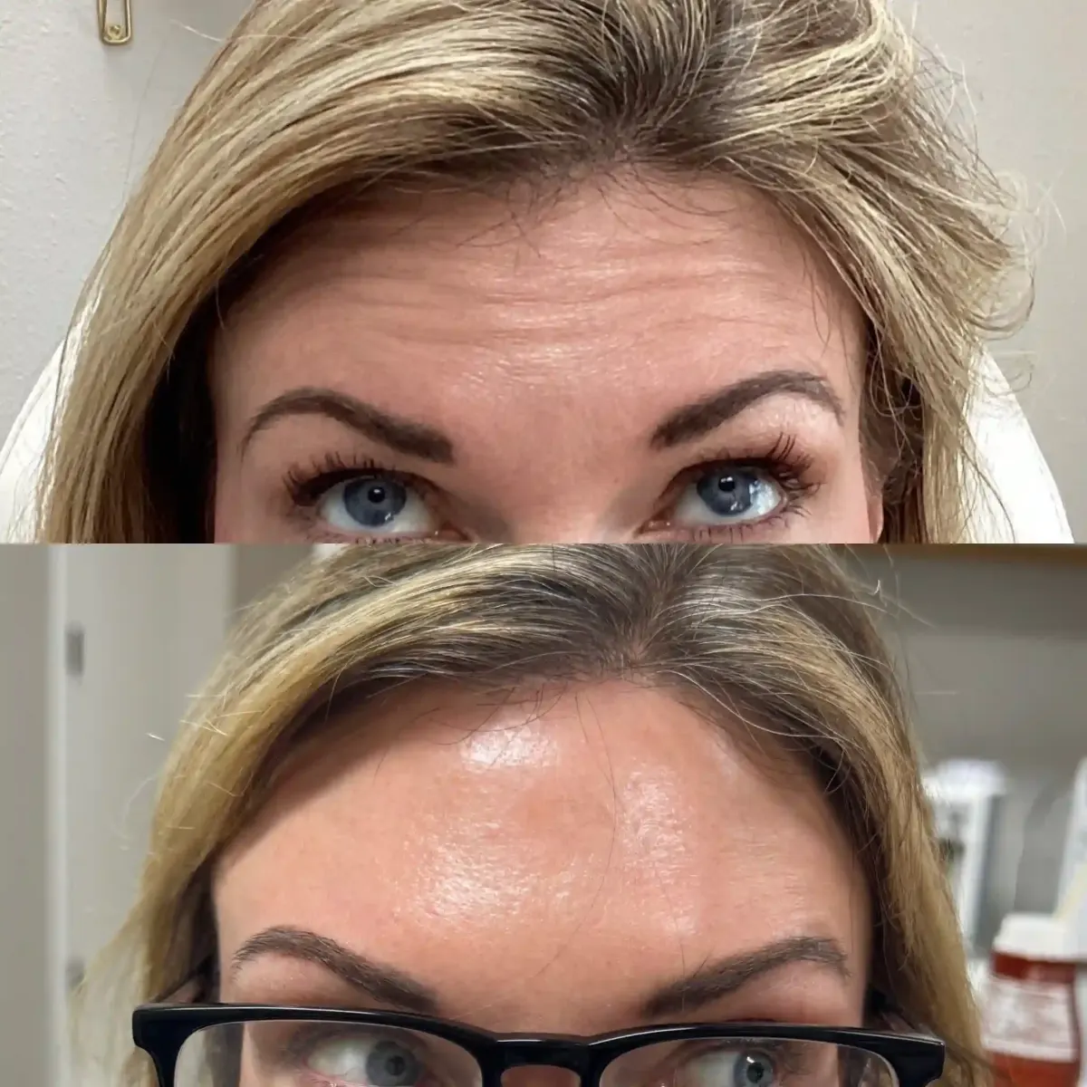 Wrinkle Relaxers m-Pure Skin and Aesthetics in-Stillwater-OK