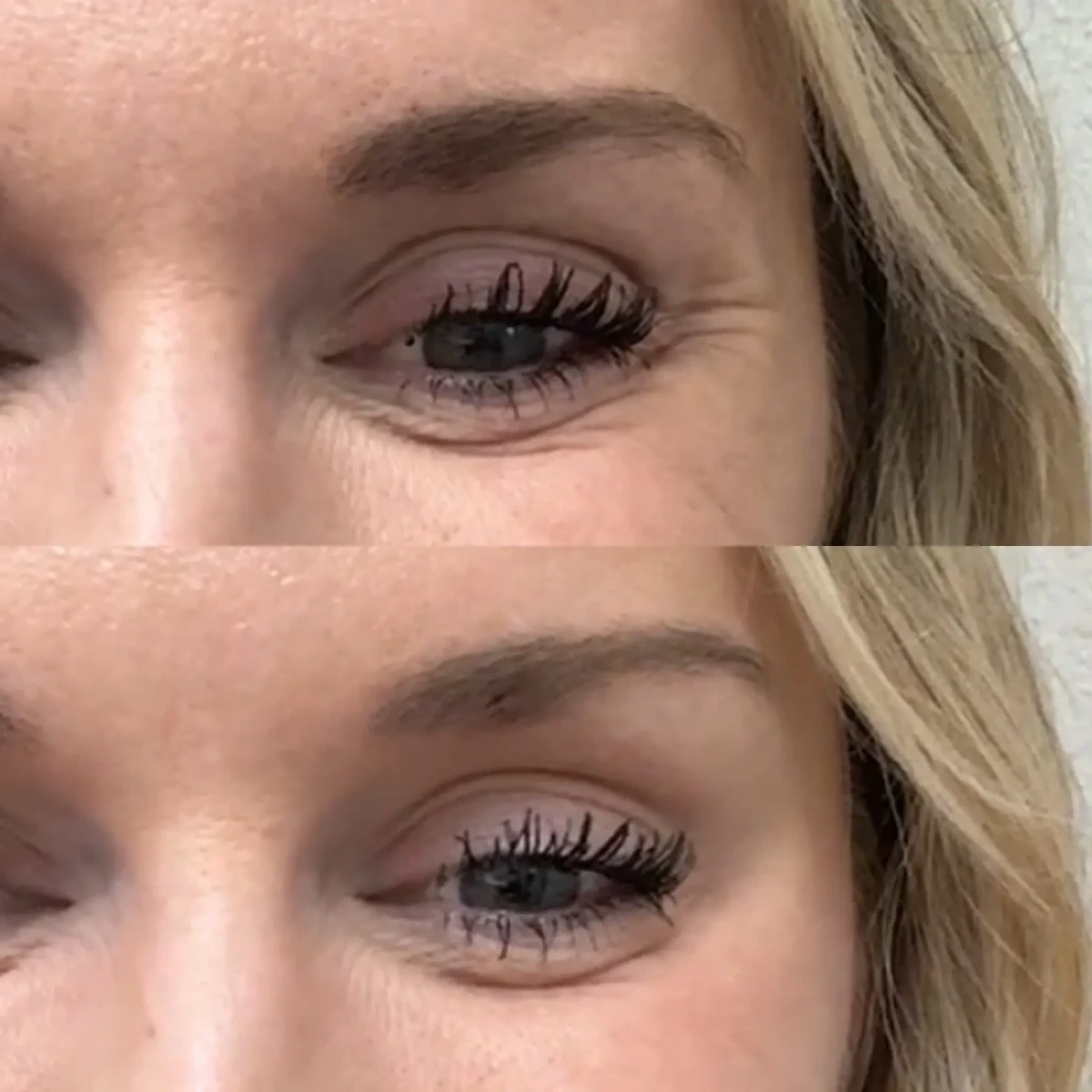 Wrinkle Relaxers n-Pure Skin and Aesthetics in-Stillwater-OK