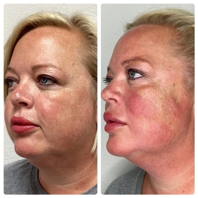 Pure Skin and AestheticsTHREADS gin-Stillwater-OK