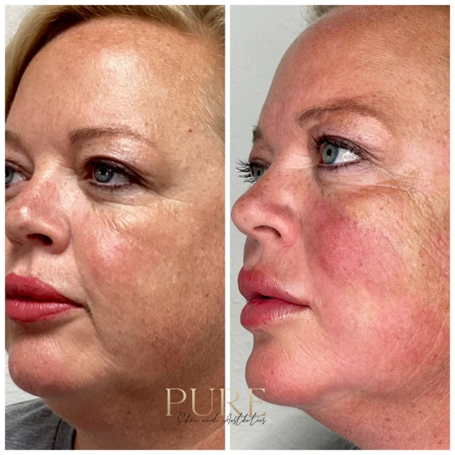 Pure Skin and AestheticsTHREADS iin-Stillwater-OK (1)
